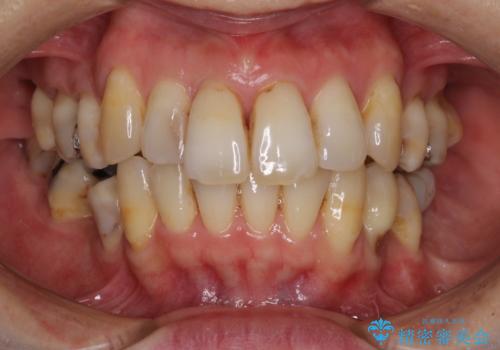 矯正中に黄ばんだ歯を白くしたいの治療前