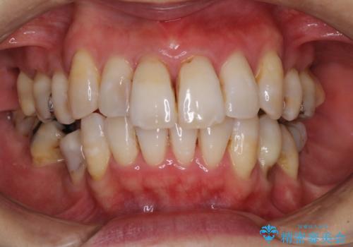 矯正中に黄ばんだ歯を白くしたいの治療後