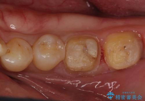 放置した虫歯の治療　親知らずの手前が虫歯の治療中