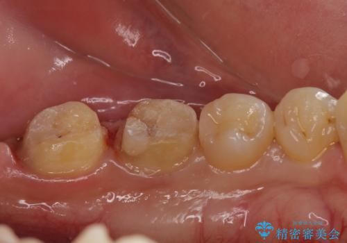 放置した虫歯の治療　親知らずの手前が虫歯の治療中