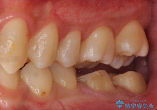 放置した虫歯の治療 親知らずの手前が虫歯の治療中