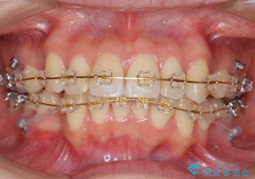 「整形した?」と言われるほどの変化! 口元を矯正治療で改善 鼻を高くしたわけでも、アゴに何か入れたわけでもありません。の治療中