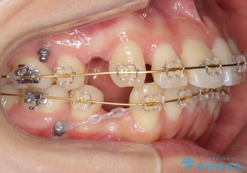 「整形した?」と言われるほどの変化! 口元を矯正治療で改善 鼻を高くしたわけでも、アゴに何か入れたわけでもありません。の治療中