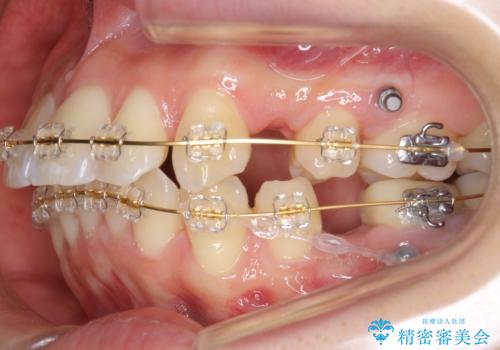 「整形した?」と言われるほどの変化! 口元を矯正治療で改善 鼻を高くしたわけでも、アゴに何か入れたわけでもありません。の治療中