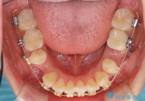 「整形した?」と言われるほどの変化! 口元を矯正治療で改善 鼻を高くしたわけでも、アゴに何か入れたわけでもありません。の治療中