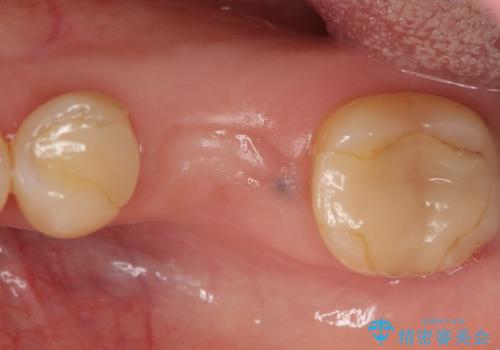 インプラント 割れてしまった歯の治療の治療前
