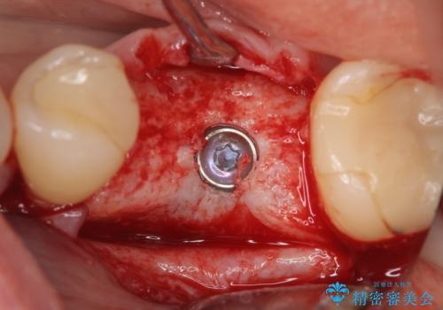 インプラント 割れてしまった歯の治療の治療中
