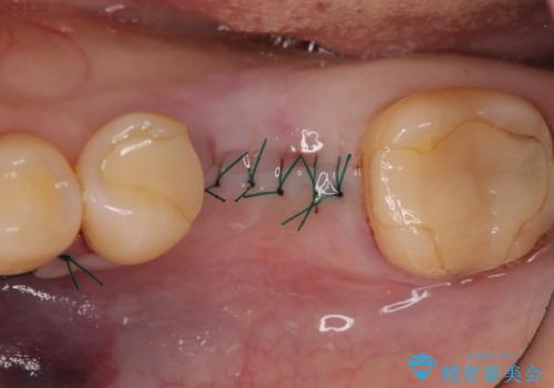 インプラント 割れてしまった歯の治療の治療後