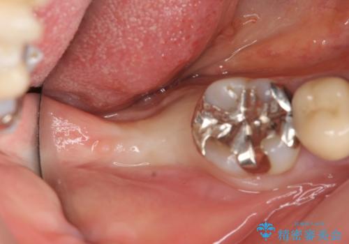 インプラント　抜歯になった奥歯の治療の治療前