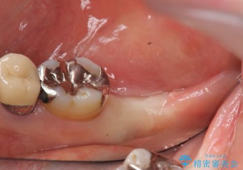 インプラント 抜歯になった奥歯の治療の治療前