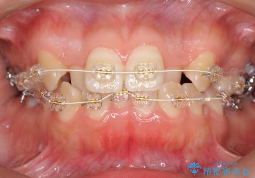 よくある悩み 前歯が裏に2本入っているのを治したいの治療中