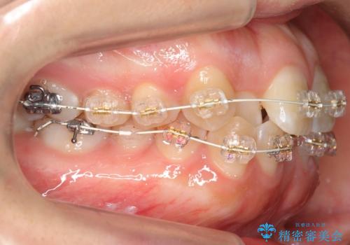 よくある悩み 前歯が裏に2本入っているのを治したいの治療中