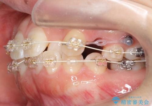 よくある悩み 前歯が裏に2本入っているのを治したいの治療中