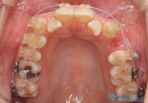 よくある悩み 前歯が裏に2本入っているのを治したいの治療中
