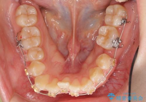 よくある悩み 前歯が裏に2本入っているのを治したいの治療中