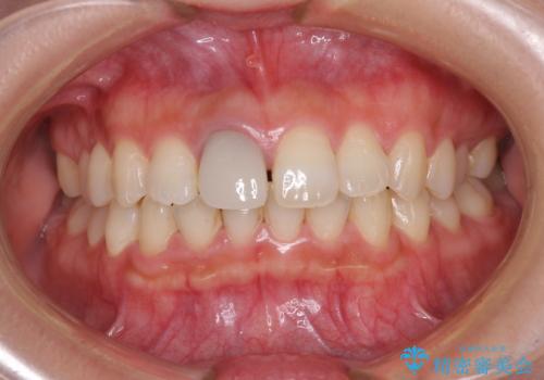 不自然なセラミッククラウンを自然なセラミックにの治療前