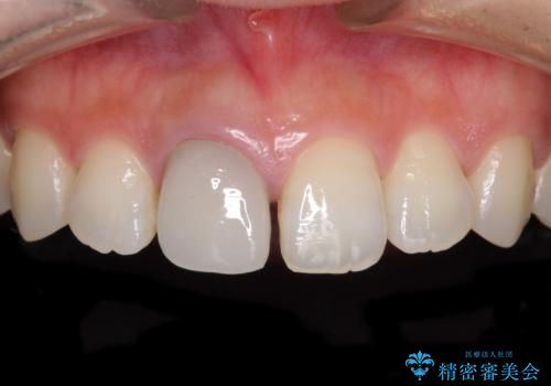 不自然なセラミッククラウンを自然なセラミックにの治療前
