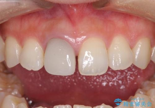 不自然なセラミッククラウンを自然なセラミックにの治療前