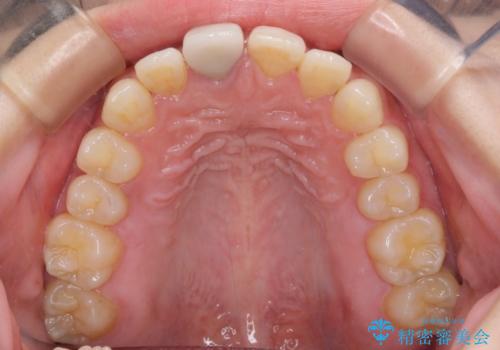 不自然なセラミッククラウンを自然なセラミックにの治療前