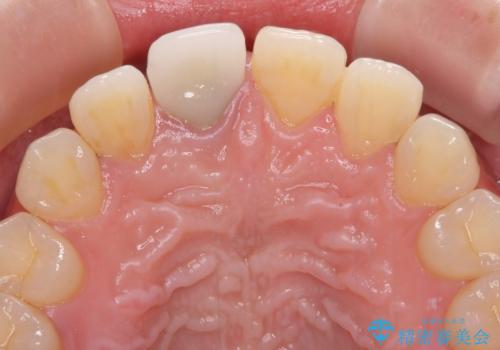 不自然なセラミッククラウンを自然なセラミックにの治療前