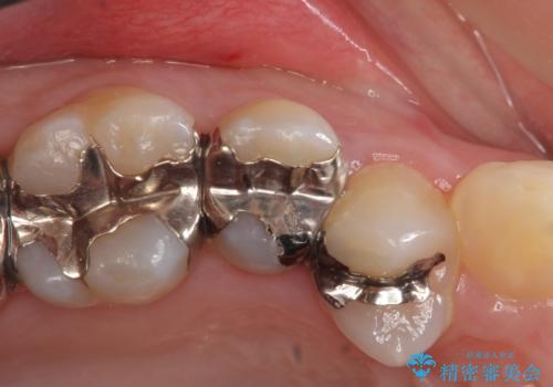 オールセラミッククラウン 銀歯を白くの治療前