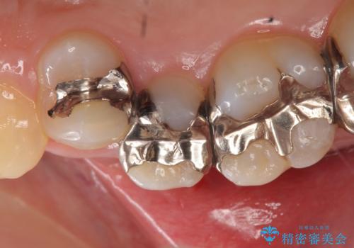 オールセラミッククラウン 銀歯を白くの治療前