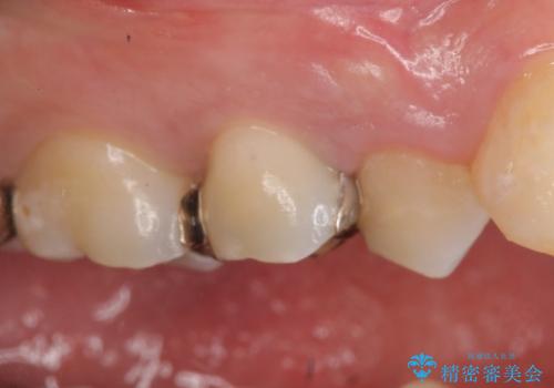 オールセラミッククラウン 銀歯を白くの症例 治療前
