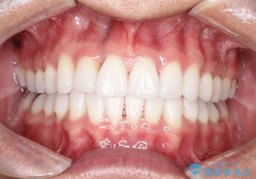内側に入ってしまった前歯を正しい位置へ  インビザライン矯正の治療後