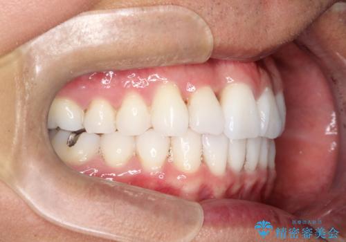 内側に入ってしまった前歯を正しい位置へ  インビザライン矯正の治療後