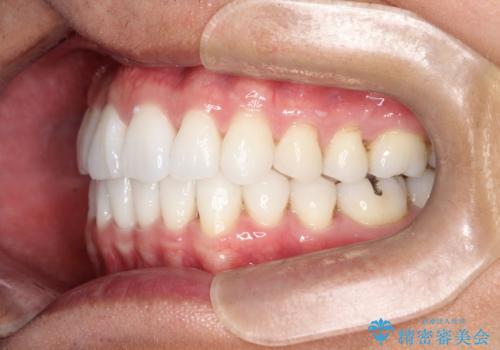 内側に入ってしまった前歯を正しい位置へ  インビザライン矯正の治療後