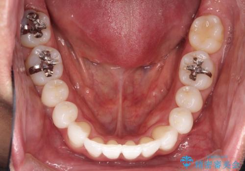 内側に入ってしまった前歯を正しい位置へ　　インビザライン矯正の治療後