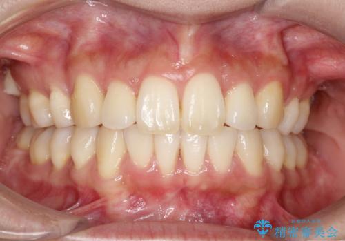 裏側装置で出っ歯の矯正治療の症例 治療後