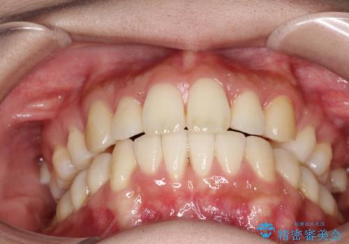 裏側装置で出っ歯の矯正治療の治療後