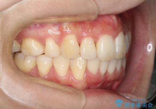 裏側装置で出っ歯の矯正治療の治療後