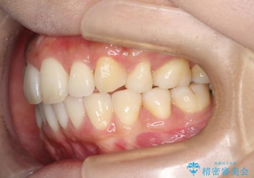 裏側装置で出っ歯の矯正治療の治療後
