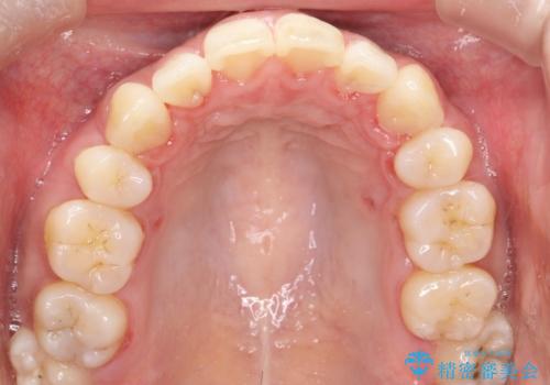 裏側装置で出っ歯の矯正治療の治療後