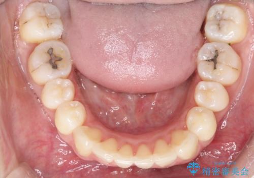裏側装置で出っ歯の矯正治療の治療後