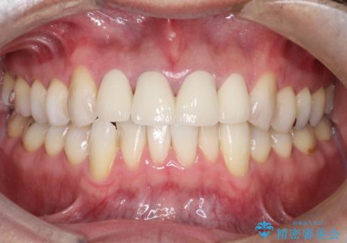 昔装着したかぶせ物を自然な色にしたい オールセラミックによる審美的改善の治療後