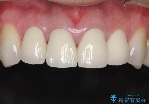 昔装着したかぶせ物を自然な色にしたい オールセラミックによる審美的改善の治療後