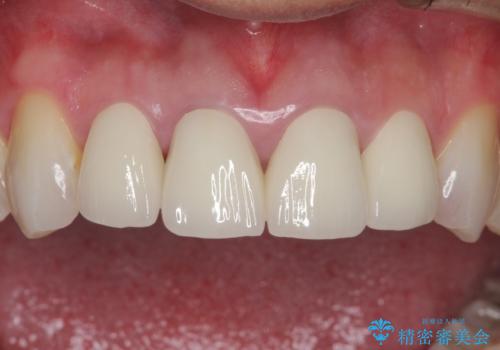 昔装着したかぶせ物を自然な色にしたい オールセラミックによる審美的改善の治療後