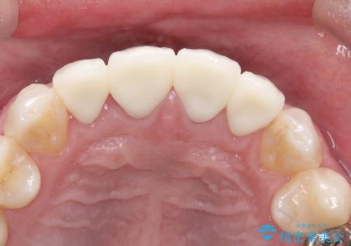 昔装着したかぶせ物を自然な色にしたい オールセラミックによる審美的改善の治療後