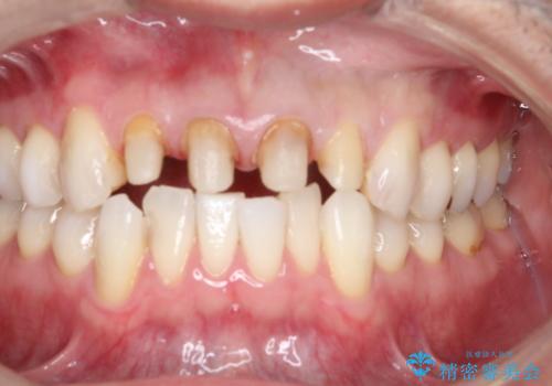 昔装着したかぶせ物を自然な色にしたい オールセラミックによる審美的改善の治療中