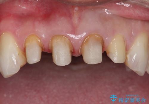 昔装着したかぶせ物を自然な色にしたい オールセラミックによる審美的改善の治療中