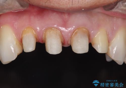 昔装着したかぶせ物を自然な色にしたい オールセラミックによる審美的改善の治療中