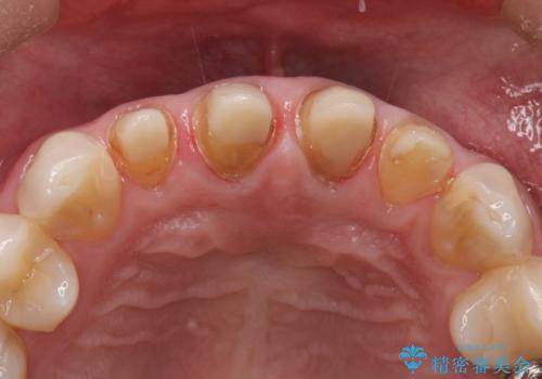 昔装着したかぶせ物を自然な色にしたい オールセラミックによる審美的改善の治療中