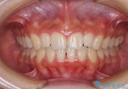 前歯のデコボコを治したい インビザラインによる矯正治療の治療後