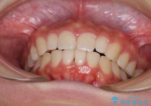 前歯のデコボコを治したい インビザラインによる矯正治療の治療後