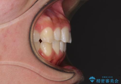 前歯のデコボコを治したい インビザラインによる矯正治療の治療後