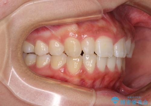 前歯のデコボコを治したい インビザラインによる矯正治療の治療後