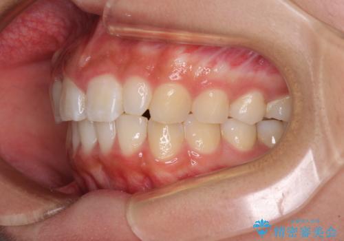 前歯のデコボコを治したい インビザラインによる矯正治療の治療後